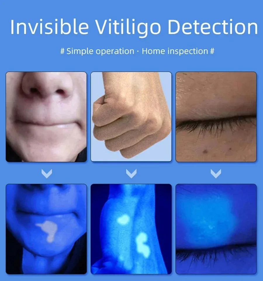 Lampe de Wood Analyseur de Peau UV - Loupe Beauté pour Test Facial et Analyse Cutanée